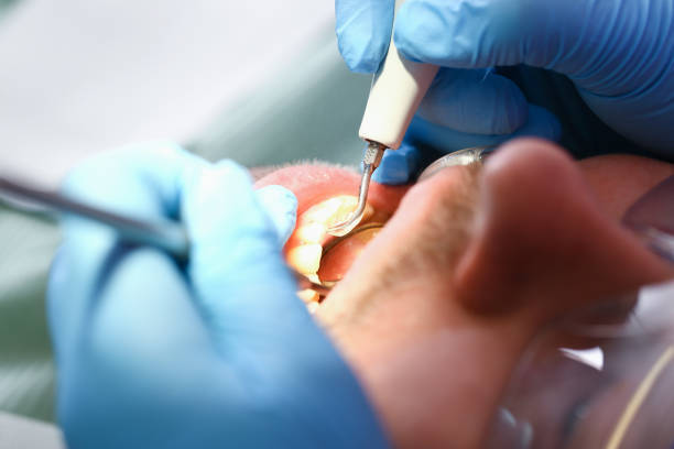 Best Emergency Tooth Extraction in Shenandoah, VA