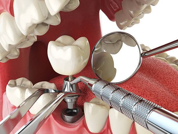 Best Emergency Tooth Extraction in Shenandoah, VA