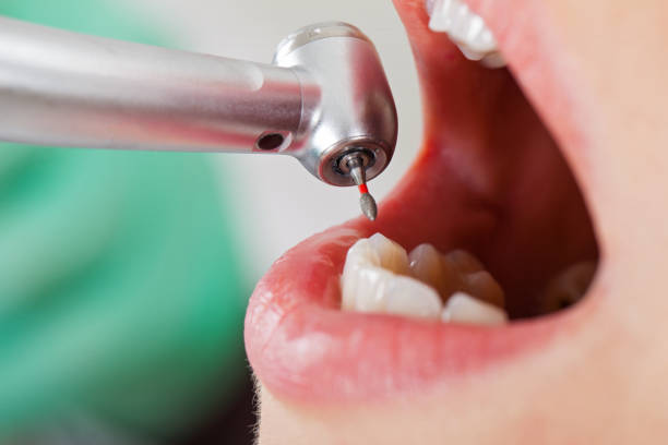 Best Emergency Root Canal Treatment in Shenandoah, VA